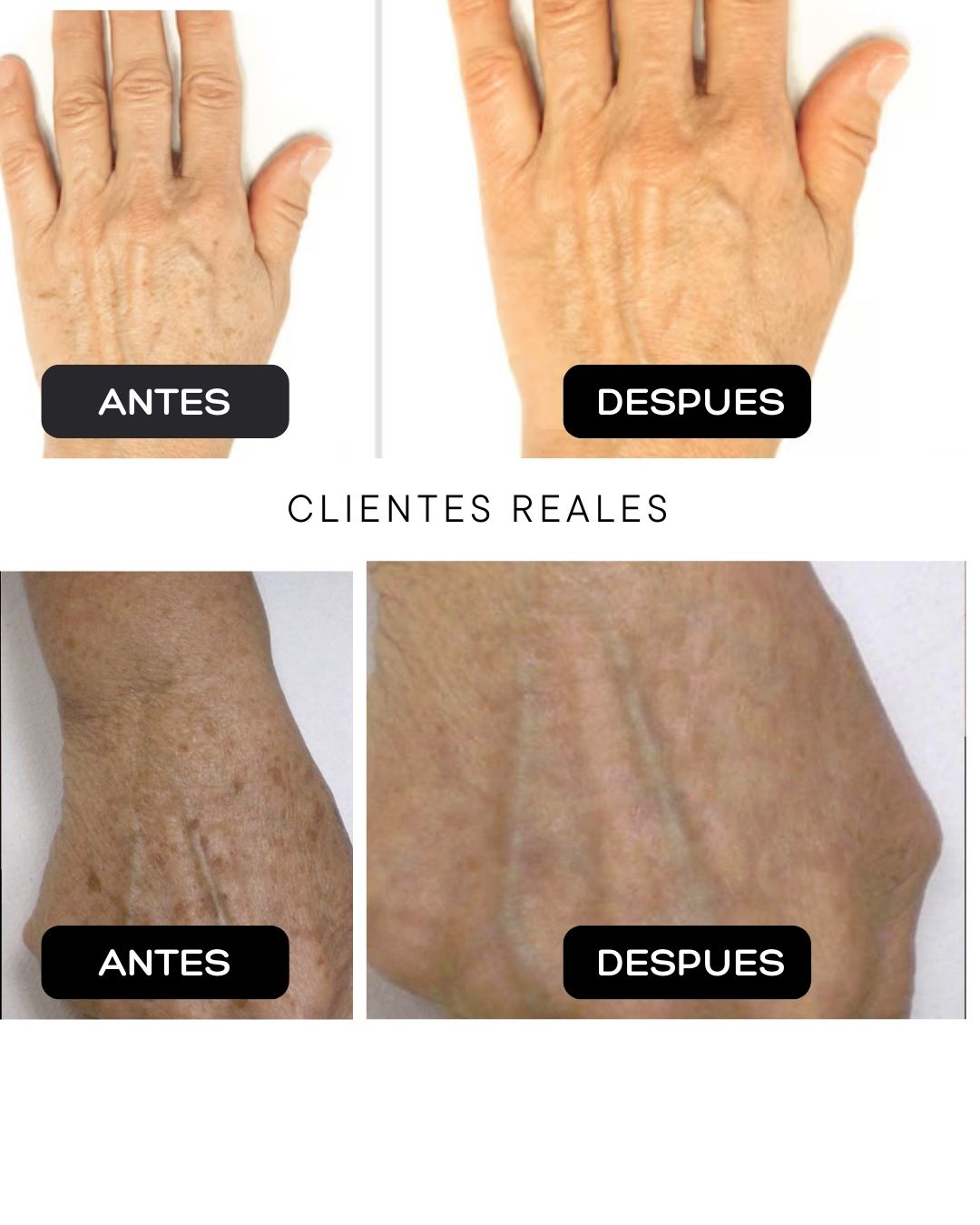 Tratamiento Aclarador para Manos – AHA 30% + BHA 2%